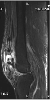 Quads rupture MRI